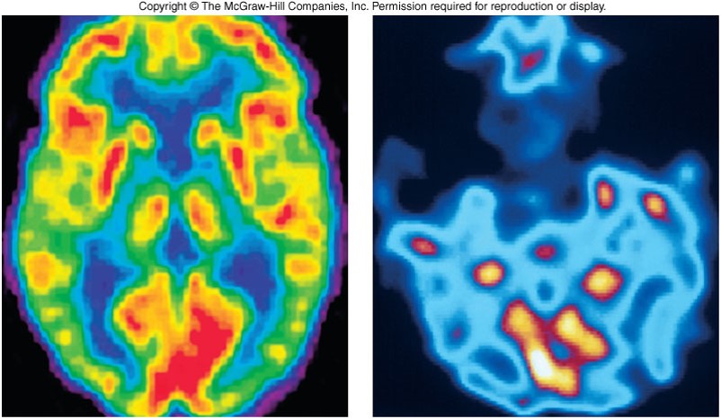 A PET scan of a healthy brain showinga lot of colors and an abnormal brain showing very little color.